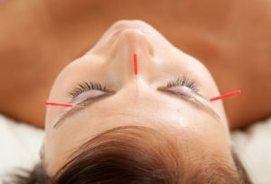 Head Acupuncture